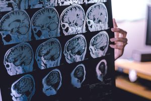 frontal lobe atrophy on MRI film probably Frontotemporal Dementia